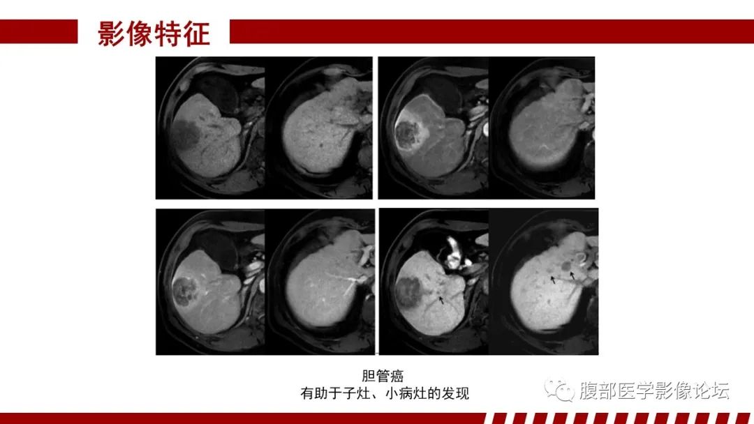 【PPT】肝胆期高信号的病变影像表现及临床意义-51
