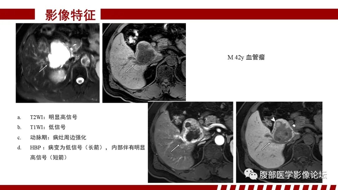 【PPT】肝胆期高信号的病变影像表现及临床意义-54