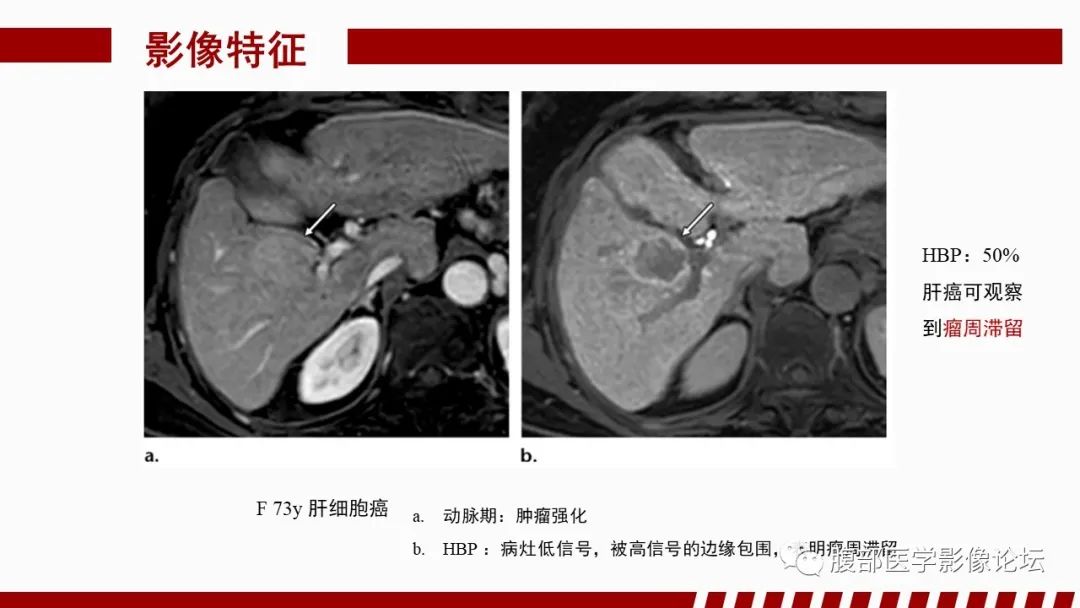 【PPT】肝胆期高信号的病变影像表现及临床意义-57