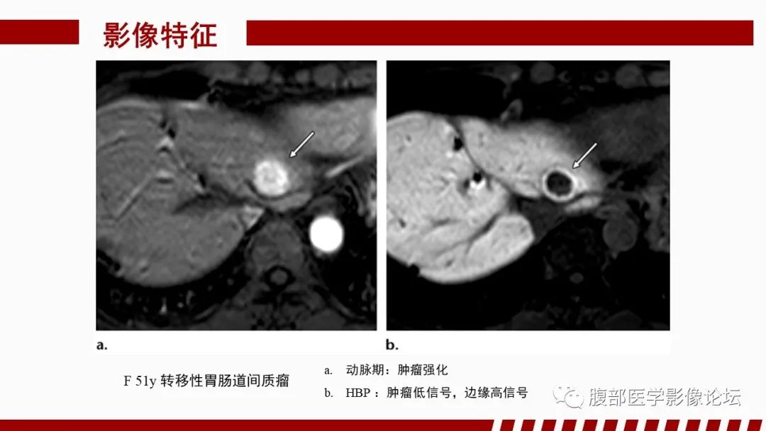 【PPT】肝胆期高信号的病变影像表现及临床意义-58