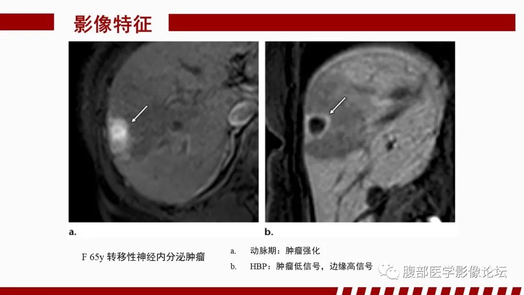 【PPT】肝胆期高信号的病变影像表现及临床意义-59