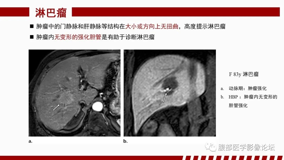 【PPT】肝胆期高信号的病变影像表现及临床意义-64