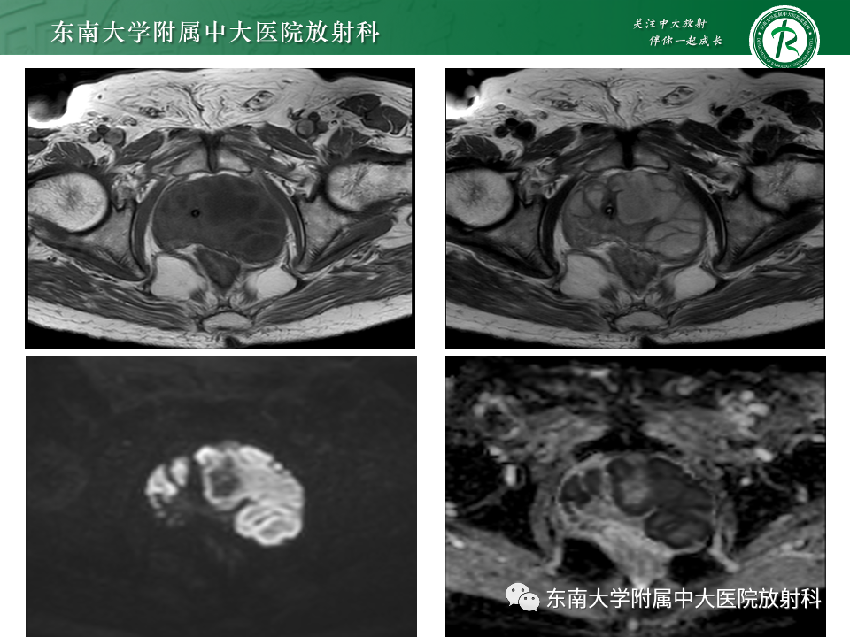 【PPT】前列腺脓肿-3
