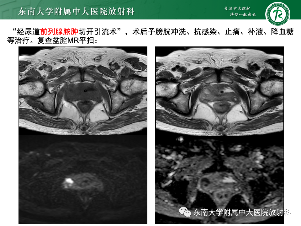 【PPT】前列腺脓肿-4