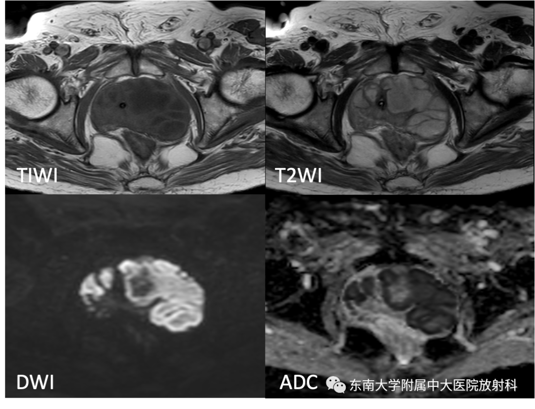 【PPT】前列腺脓肿-1