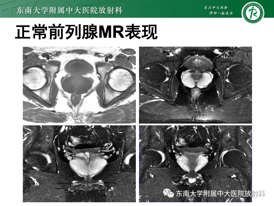 【PPT】前列腺脓肿-9