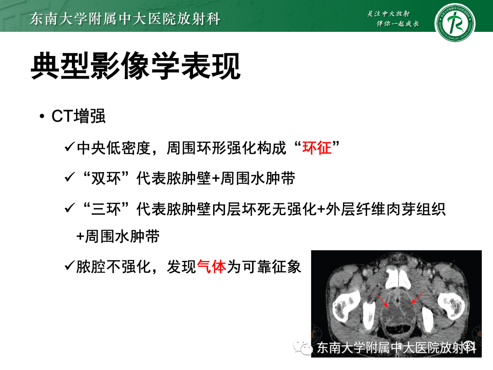 【PPT】前列腺脓肿-17