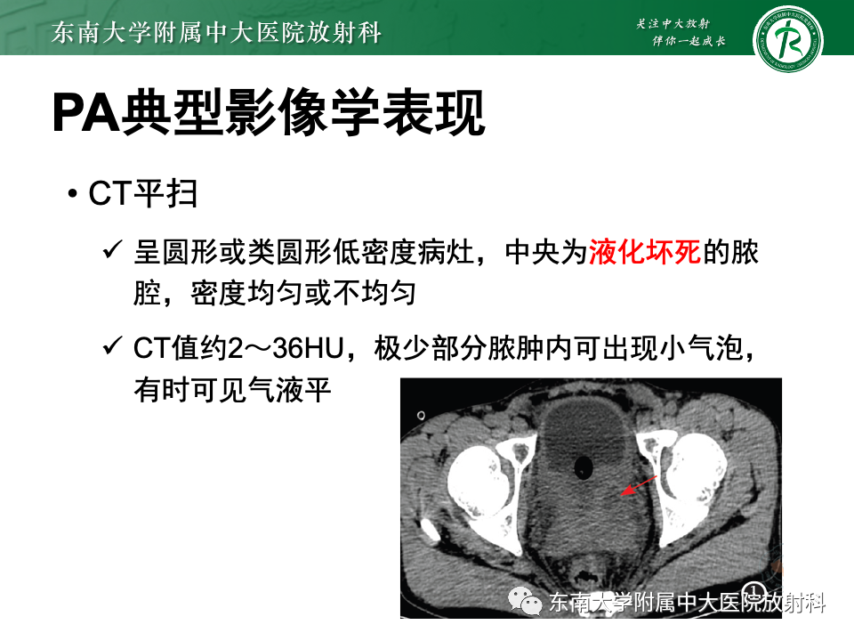 【PPT】前列腺脓肿-16