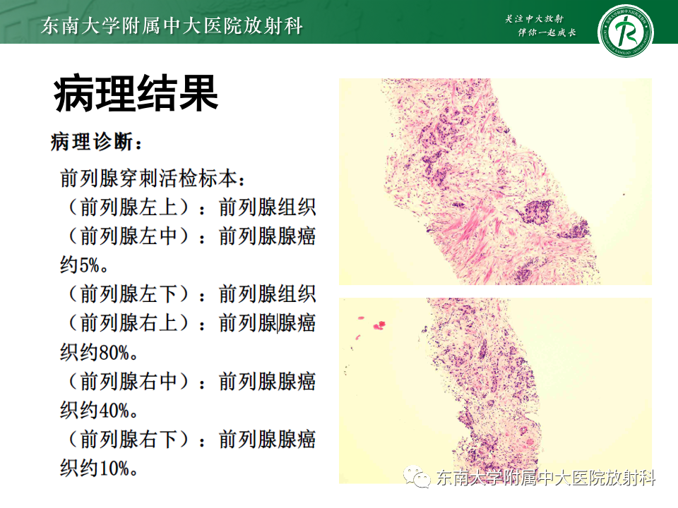 【PPT】前列腺脓肿-22