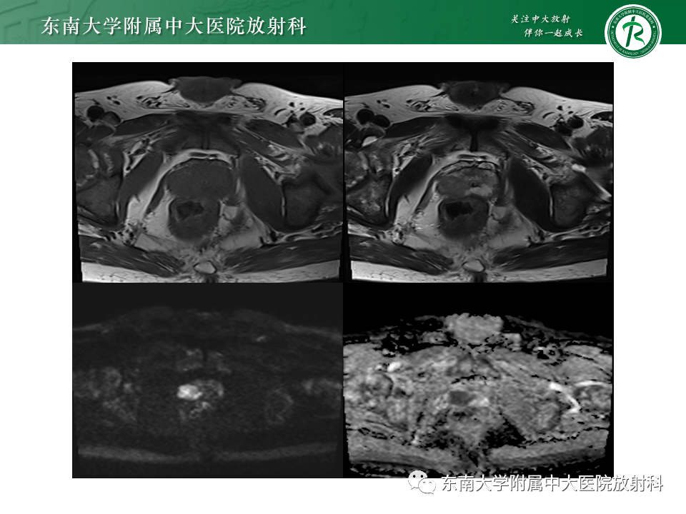 【PPT】前列腺脓肿-21