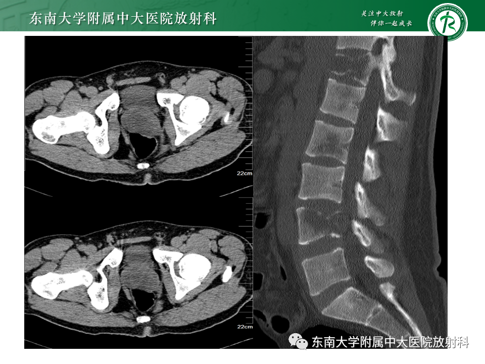 【PPT】前列腺脓肿-28