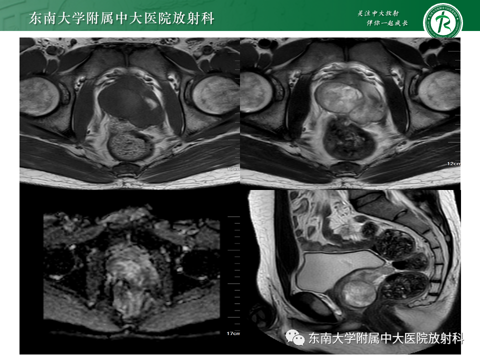 【PPT】前列腺脓肿-29