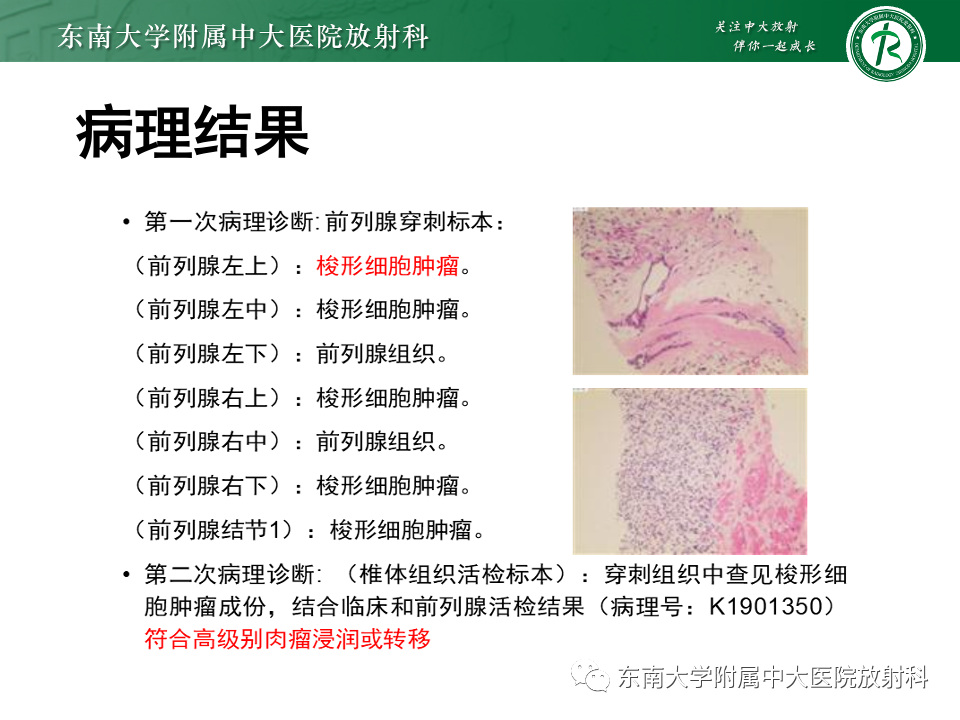 【PPT】前列腺脓肿-30