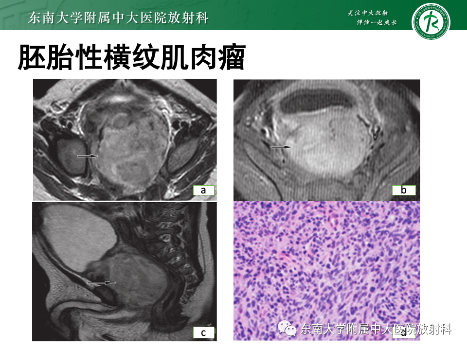 【PPT】前列腺脓肿-33