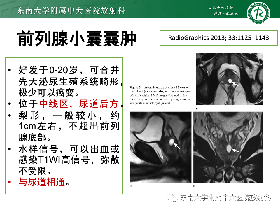 【PPT】前列腺脓肿-35