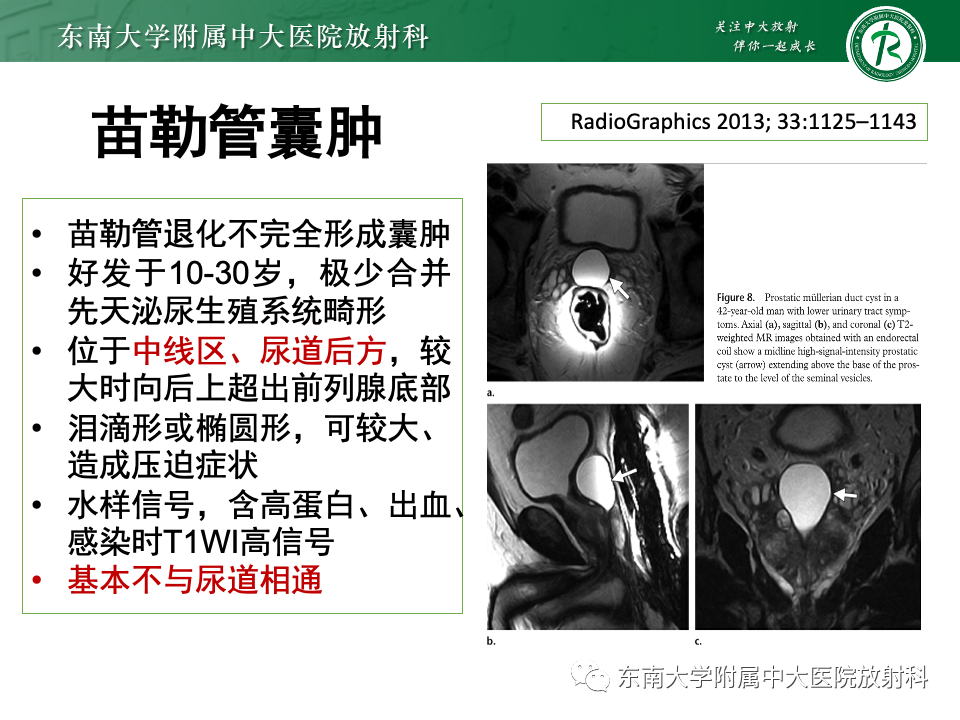 【PPT】前列腺脓肿-36