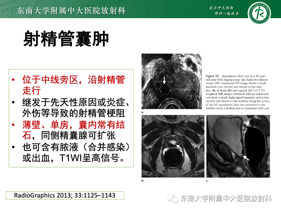 【PPT】前列腺脓肿-38