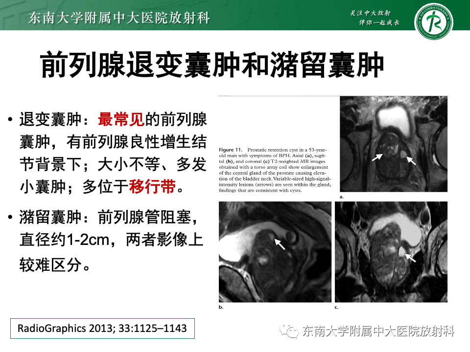 【PPT】前列腺脓肿-39