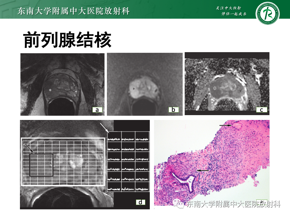 【PPT】前列腺脓肿-41