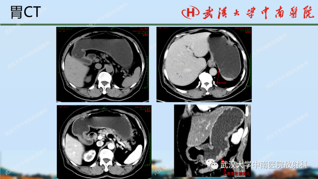 【PPT】胃占位病变影像诊断分析-6