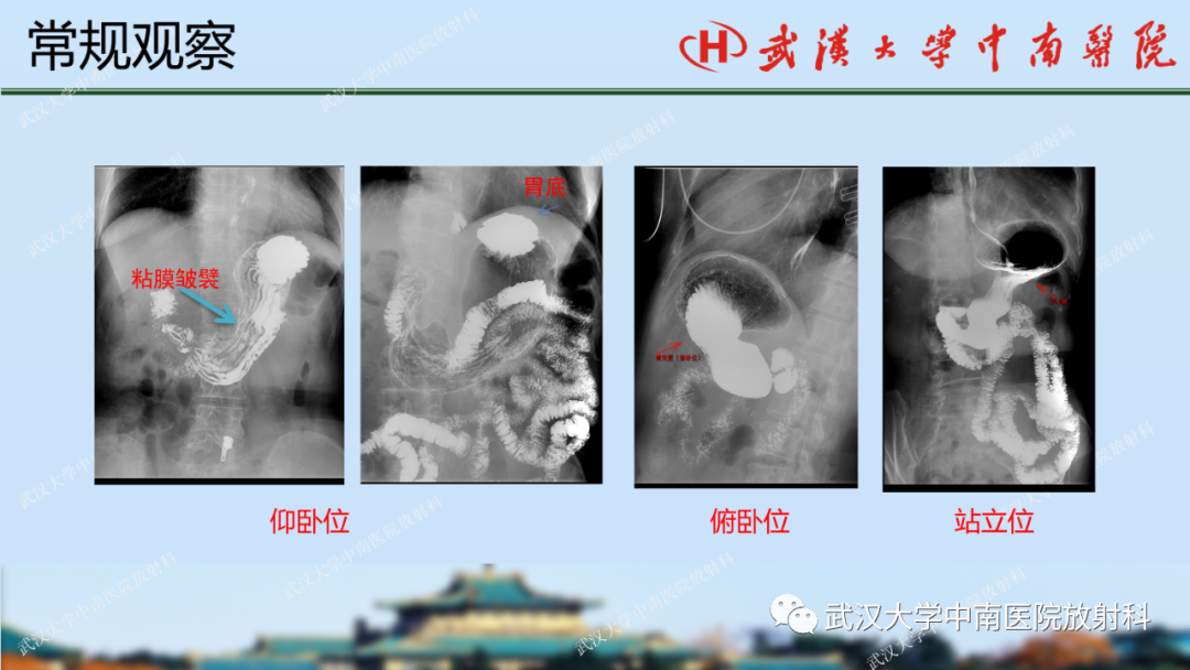 【PPT】胃占位病变影像诊断分析-10