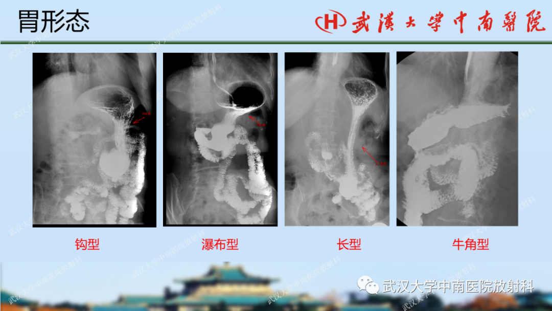 【PPT】胃占位病变影像诊断分析-9
