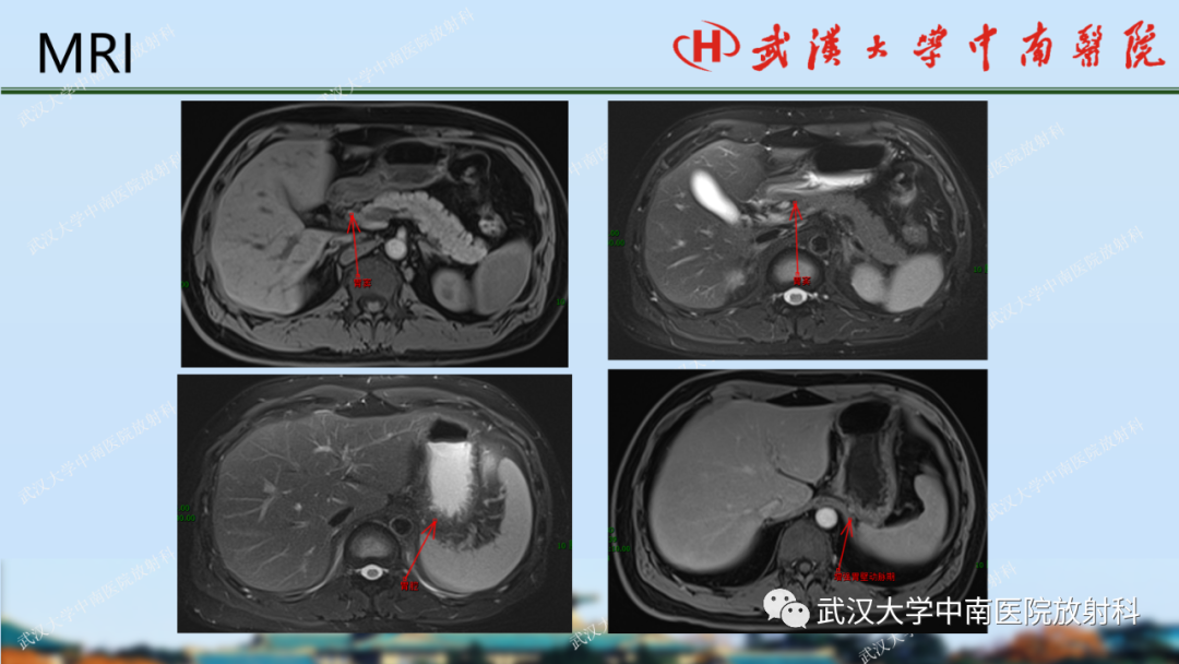 【PPT】胃占位病变影像诊断分析-12