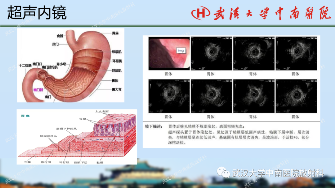 【PPT】胃占位病变影像诊断分析-13