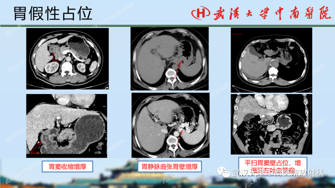 【PPT】胃占位病变影像诊断分析-17