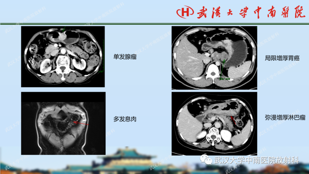 【PPT】胃占位病变影像诊断分析-20