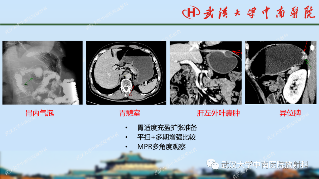 【PPT】胃占位病变影像诊断分析-18