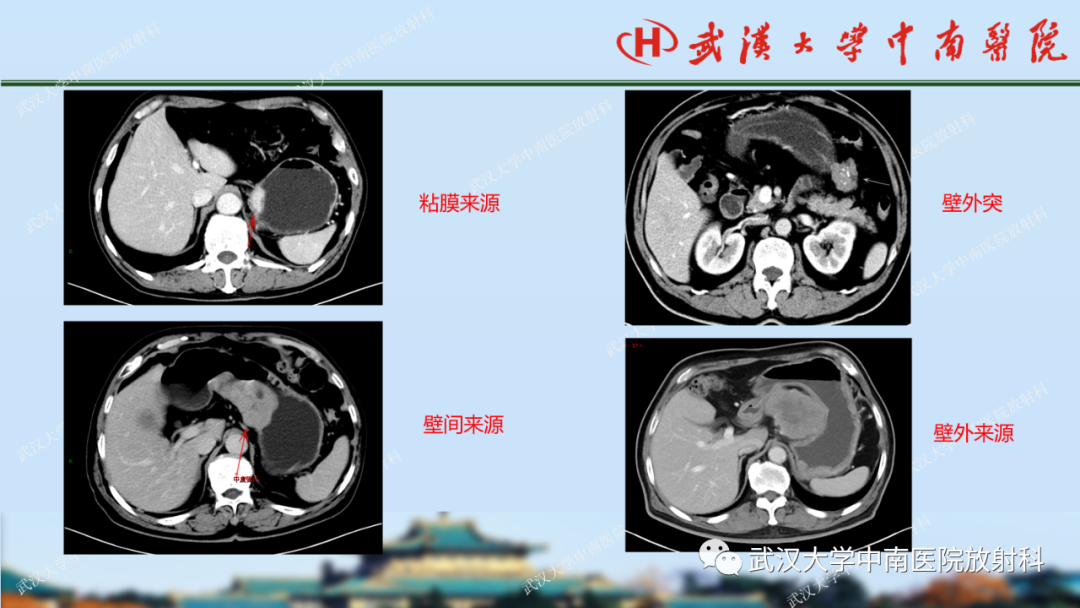 【PPT】胃占位病变影像诊断分析-22