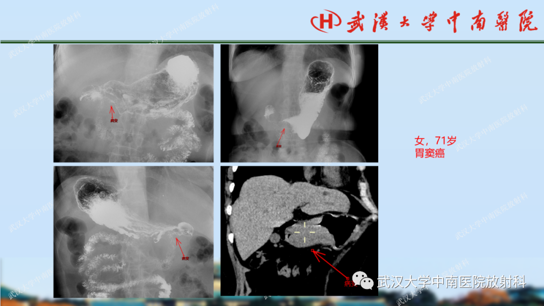 【PPT】胃占位病变影像诊断分析-23