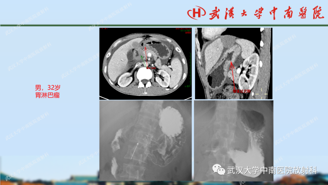 【PPT】胃占位病变影像诊断分析-24