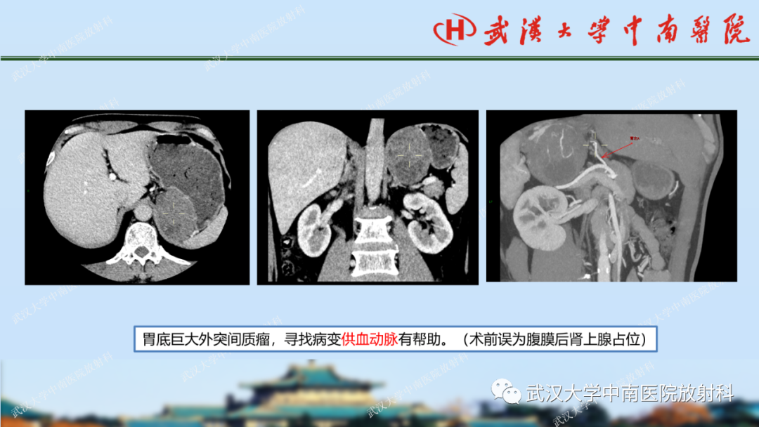 【PPT】胃占位病变影像诊断分析-26
