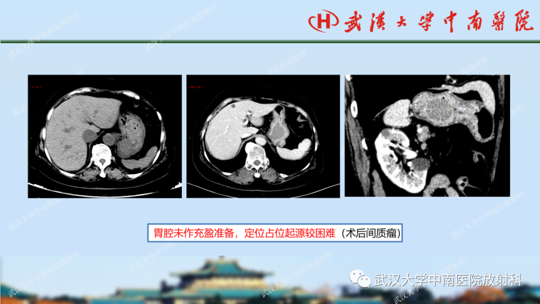 【PPT】胃占位病变影像诊断分析-25