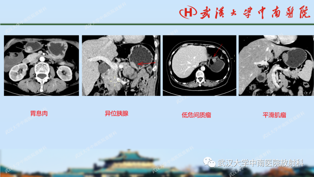 【PPT】胃占位病变影像诊断分析-28