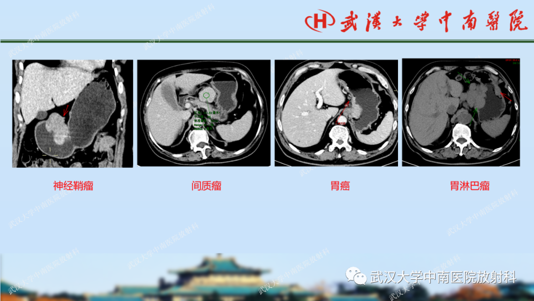 【PPT】胃占位病变影像诊断分析-29