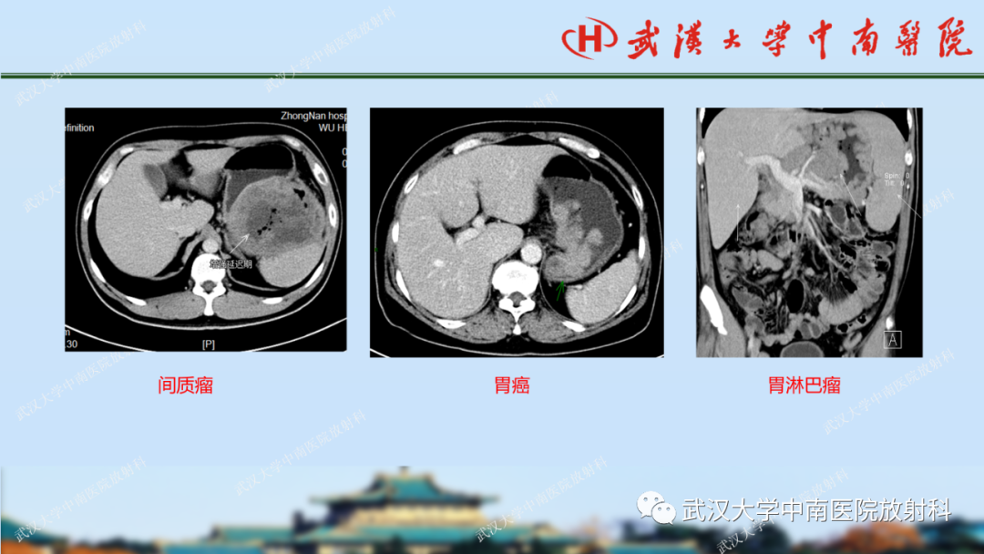 【PPT】胃占位病变影像诊断分析-30
