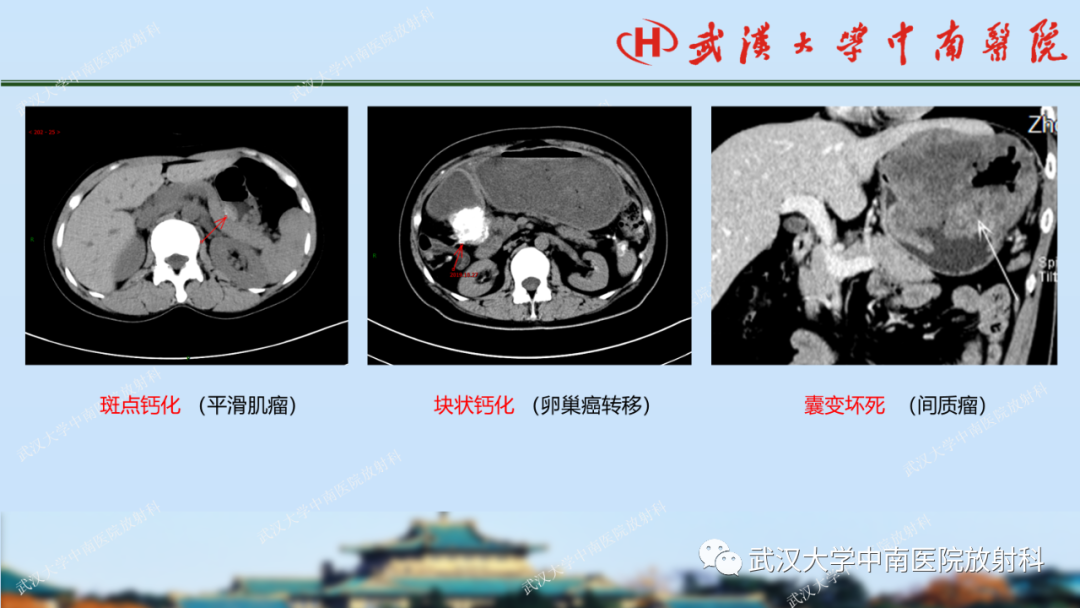 【PPT】胃占位病变影像诊断分析-32