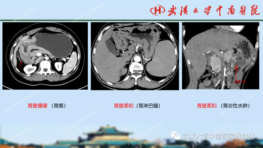 【PPT】胃占位病变影像诊断分析-33