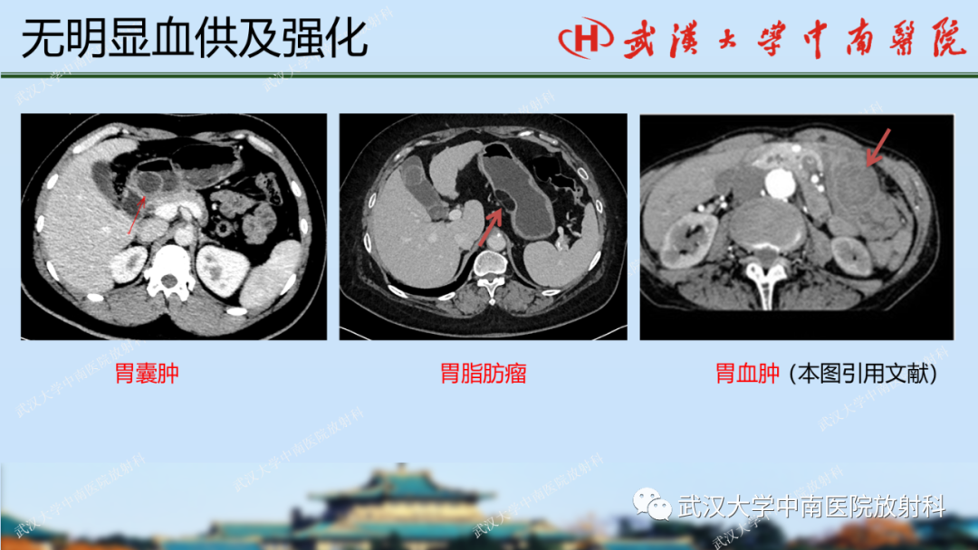 【PPT】胃占位病变影像诊断分析-35