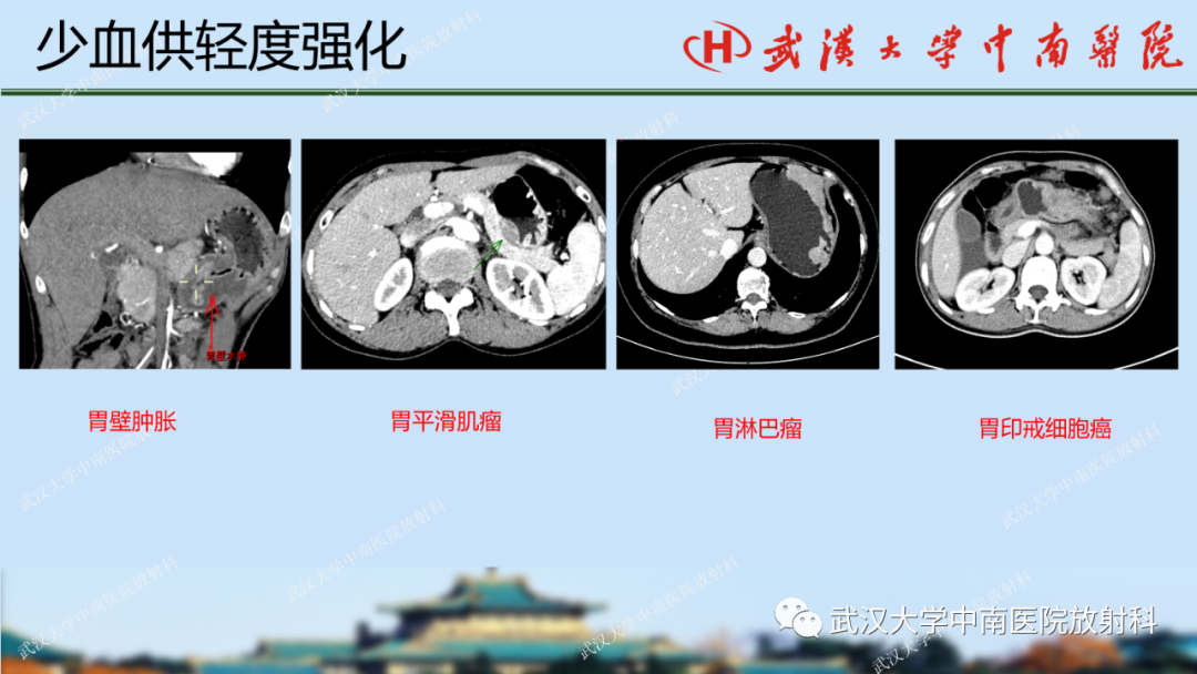 【PPT】胃占位病变影像诊断分析-36