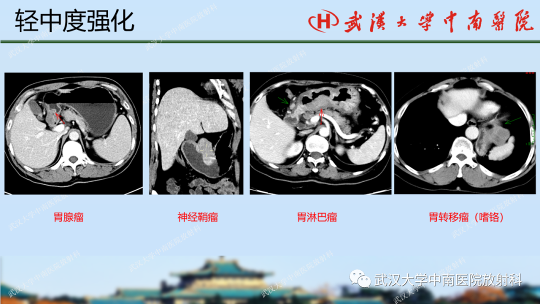 【PPT】胃占位病变影像诊断分析-37