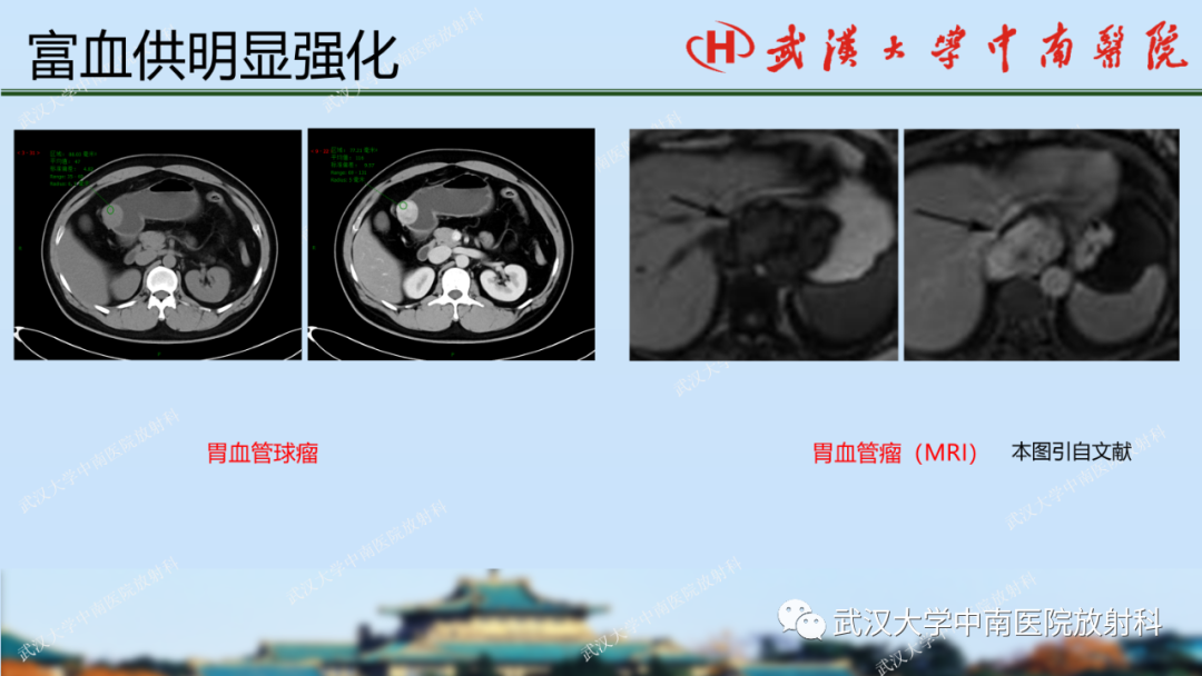 【PPT】胃占位病变影像诊断分析-39