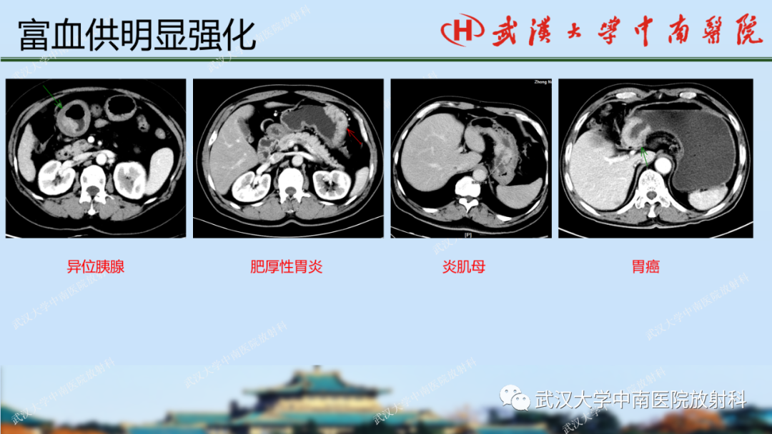 【PPT】胃占位病变影像诊断分析-38
