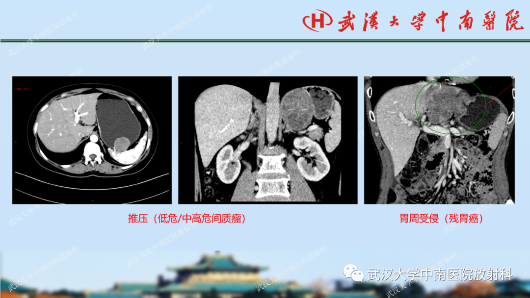 【PPT】胃占位病变影像诊断分析-41