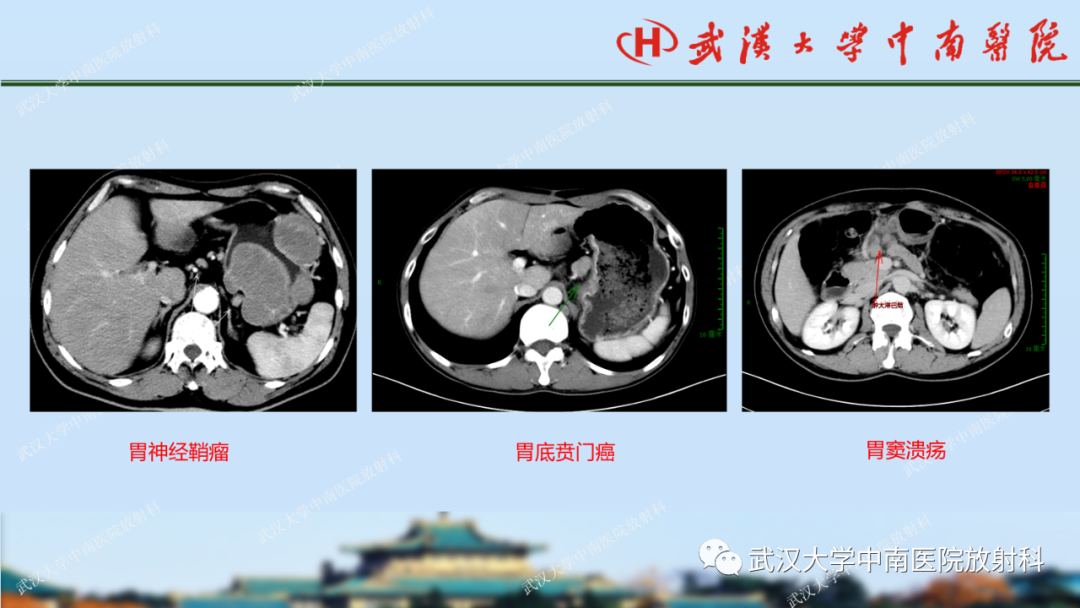 【PPT】胃占位病变影像诊断分析-42