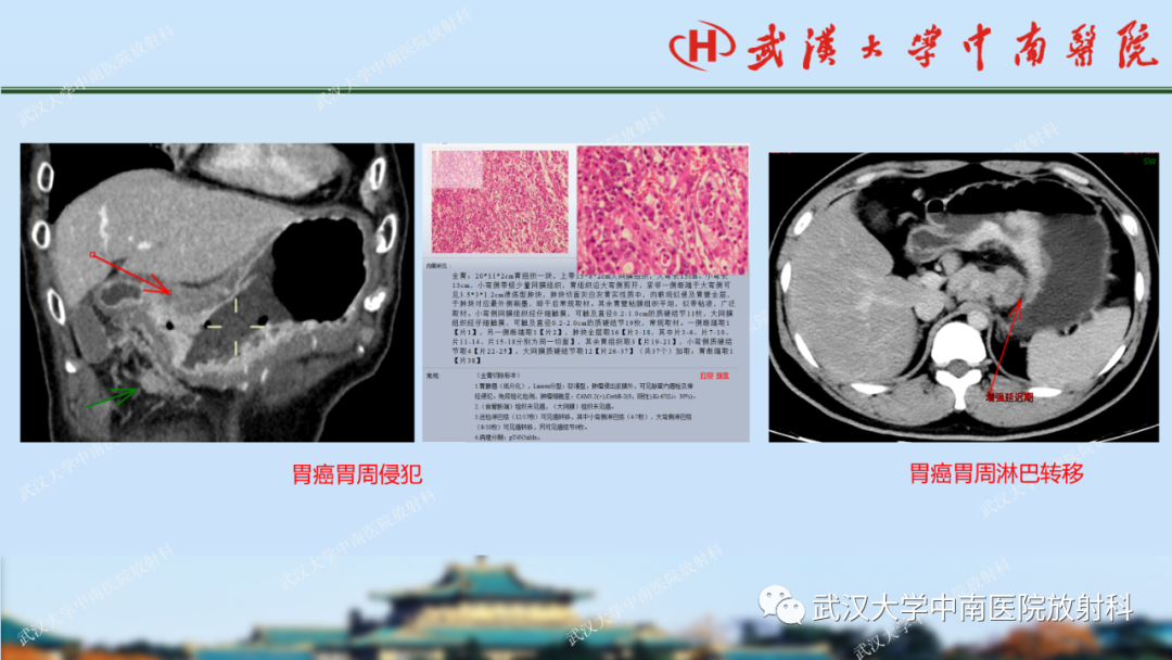 【PPT】胃占位病变影像诊断分析-44