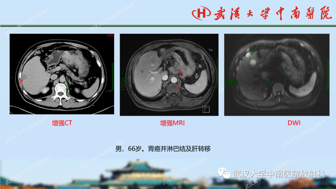 【PPT】胃占位病变影像诊断分析-45